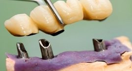 Fixed Implant Crowns West Houston