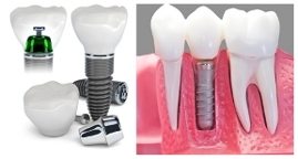 Dental Implants West Houston