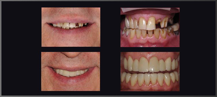 Crowns and Veneers