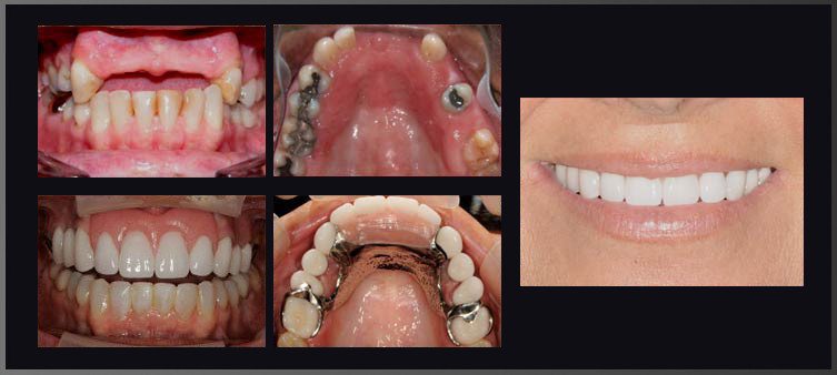 Crowns and Veneers