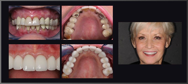 crowns and veneers